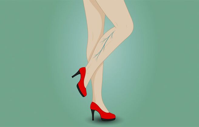 Varicose veins on a woman's feet