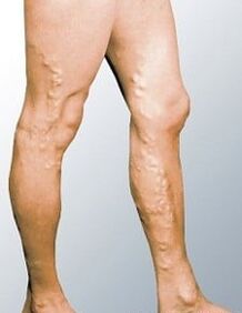 Varicose veins in men's legs