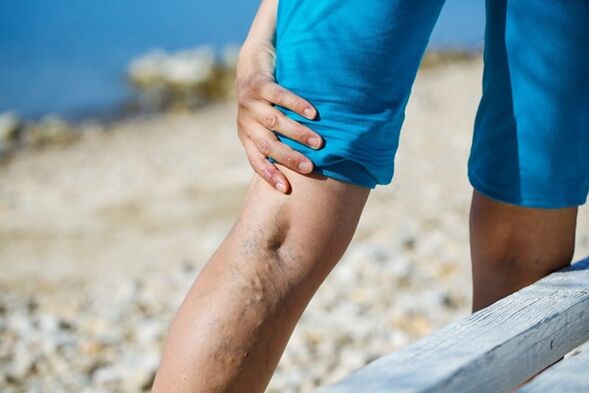 Disturbing pain in the legs with varicose veins