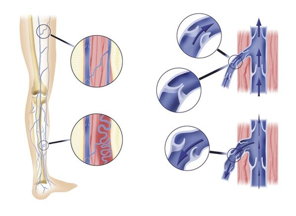 Inefficient venous valves lead to varicose veins