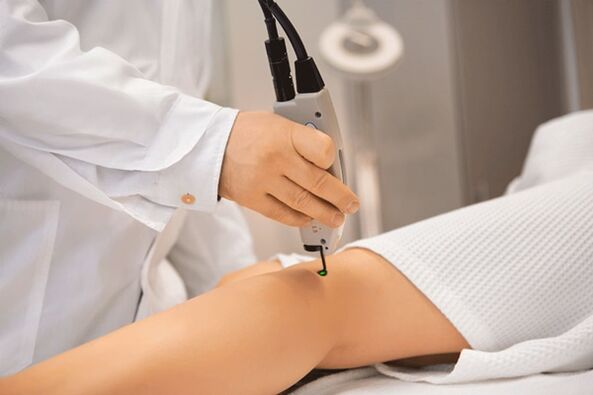 Laser coagulation of lower extremity veins