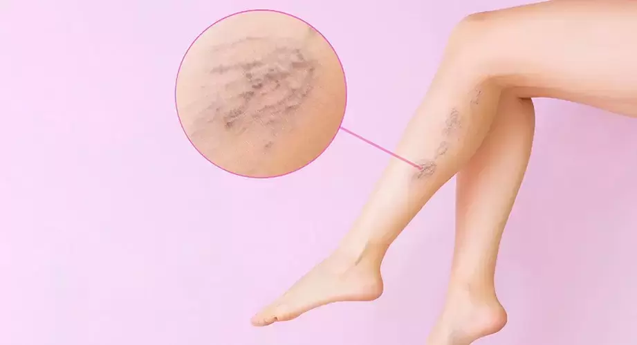 Prominent veins in the legs with varicose veins