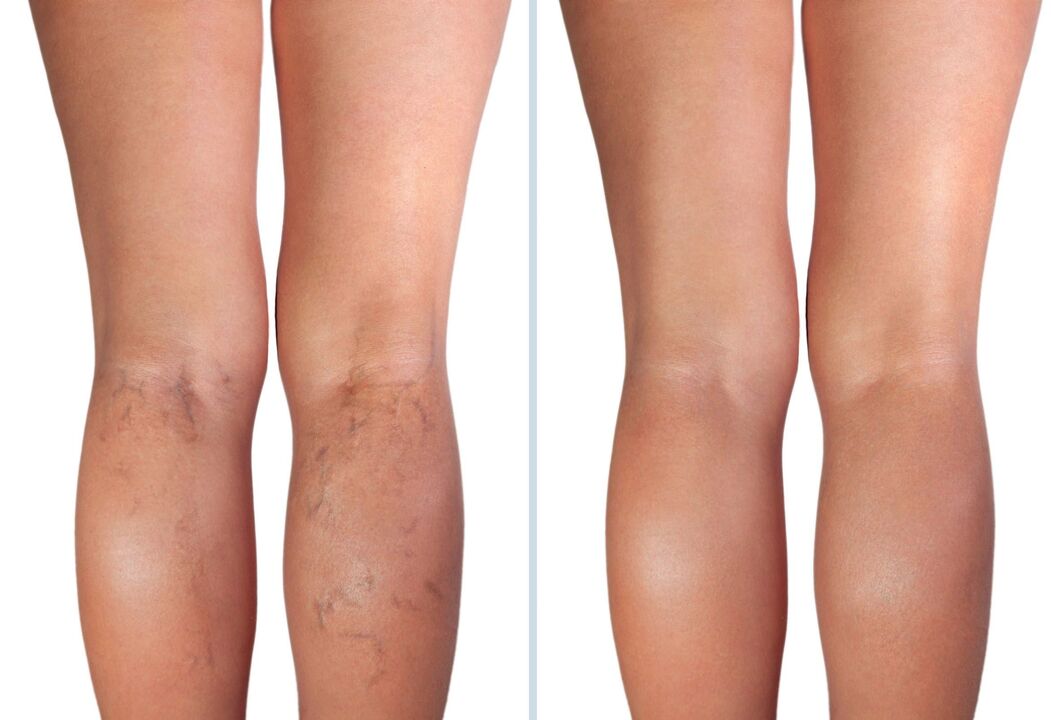 stage of varicose veins