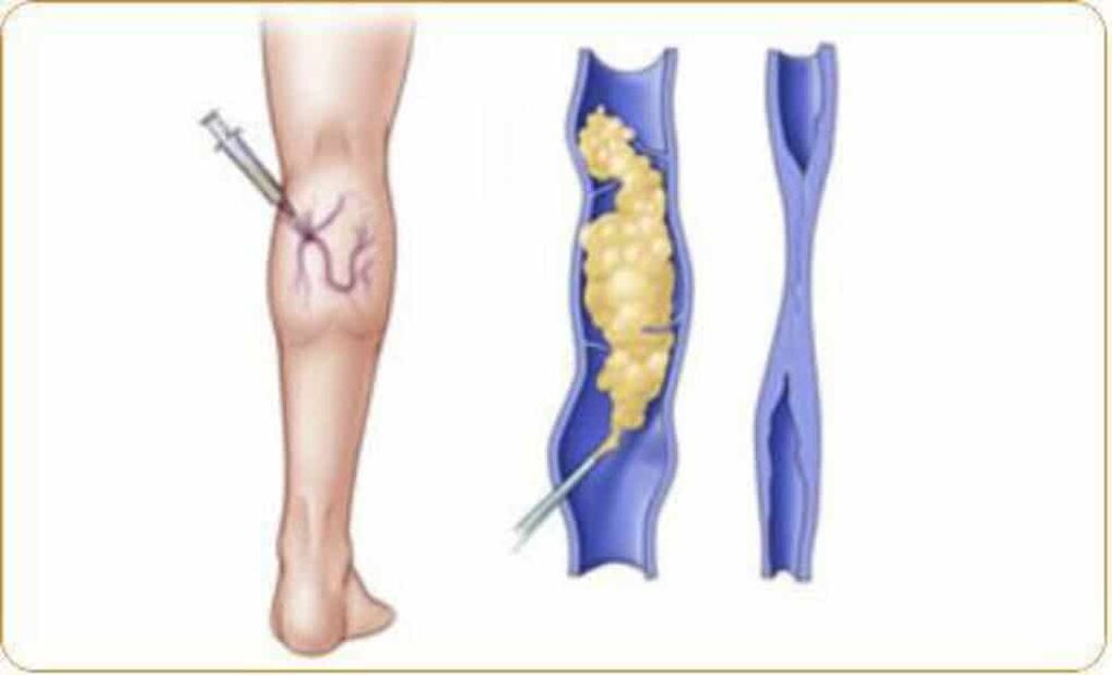 Examples of sclerotherapy procedures for varicose veins and clear results