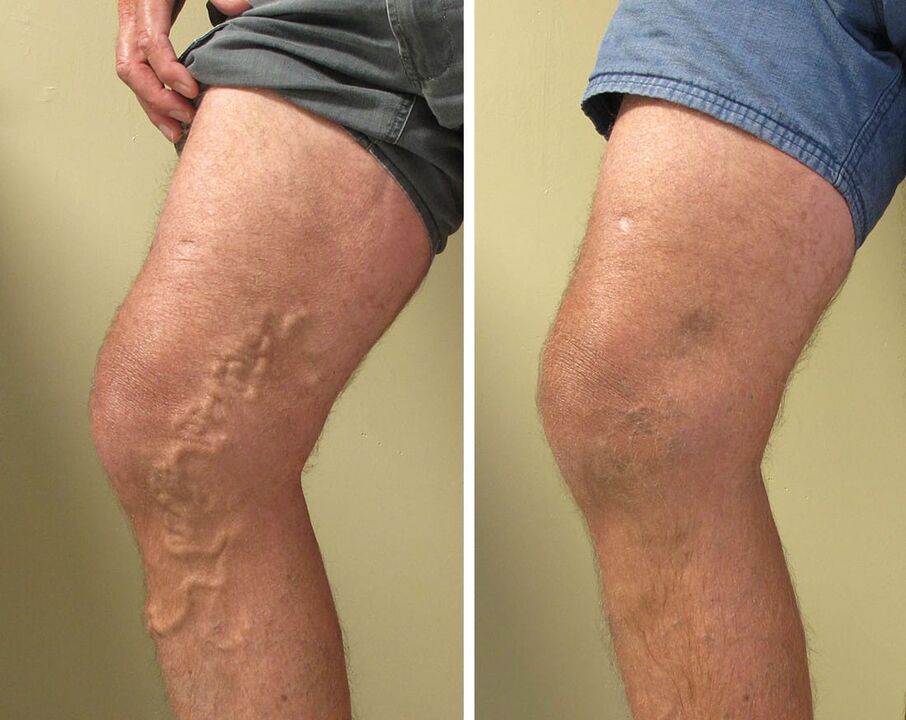 Superficial varicose veins should not be ignored